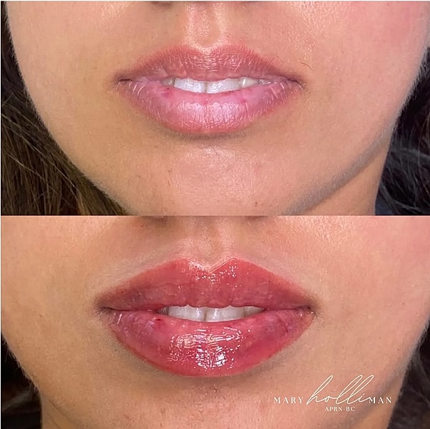 Before and after lip enhancement treatment comparison.