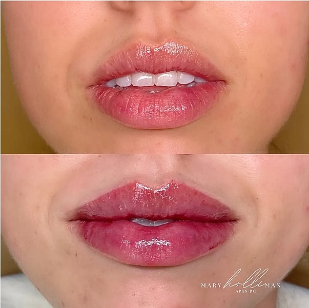 Before and after lip enhancement results