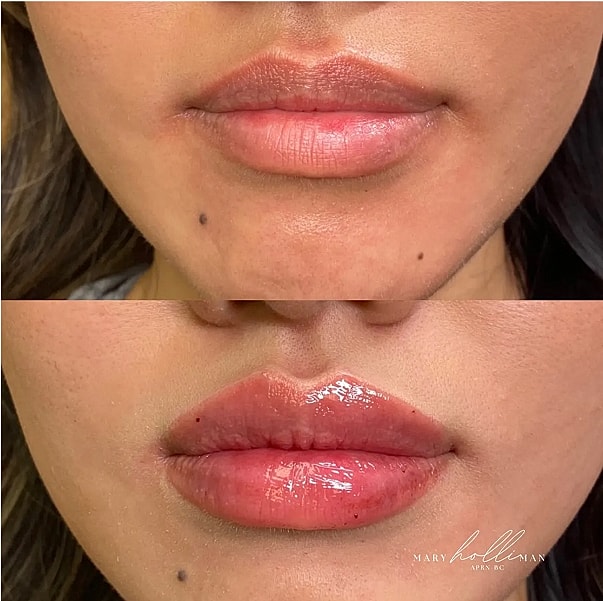 Before and after lip enhancement treatment.