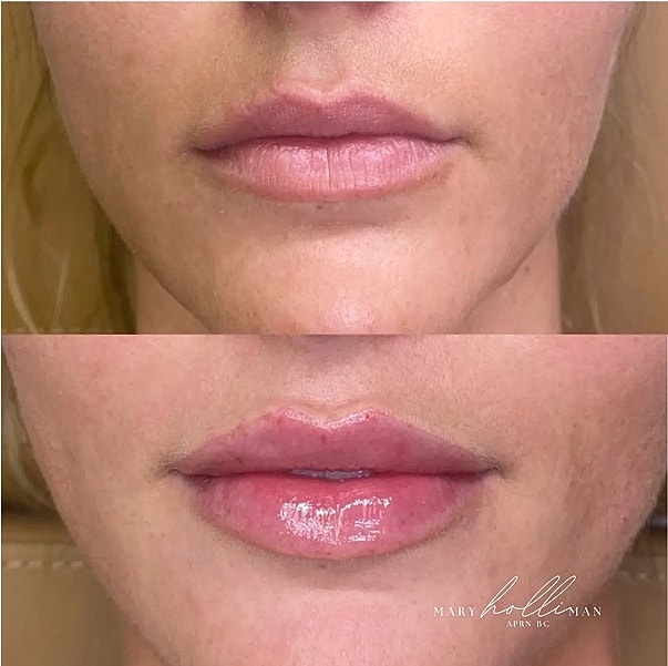 Before and after lip enhancement treatment.