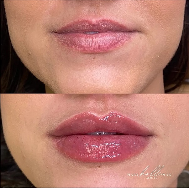 Before and after lip enhancement treatment results.
